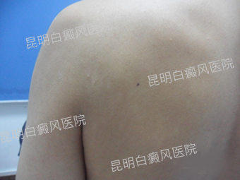 坚定乐观勇敢,战胜白斑病魔