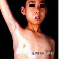 儿童长白癜风怎么办 儿童长白癜风怎么办