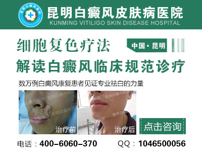 昆明哪家医院专治白癜风