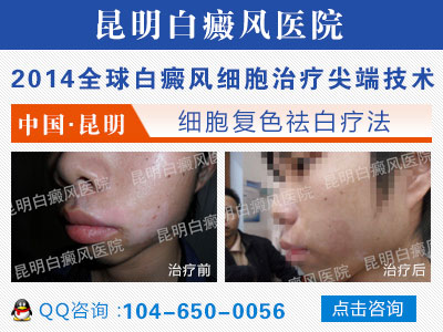 白癜风治疗昆明哪家效果好