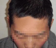 治疗三个多月后,雷先生的白斑已经完全消失.jpg