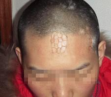 治疗一个月后,雷先生白斑处的白斑逐渐在减淡,有大量黑色素生成.jpg