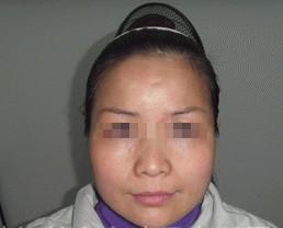 治疗四个月后,郑女士的白癜风已经完全消失.jpg