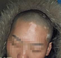 雷先生初诊时的症状图片.jpg
